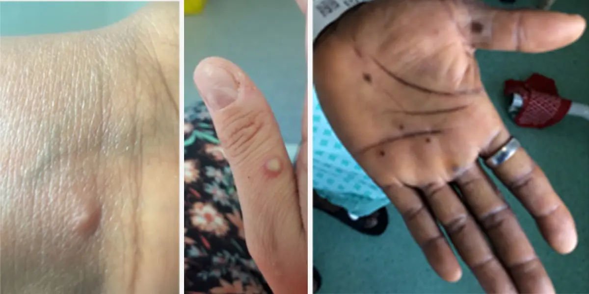 (Imágenes: Red de enfermedades infecciosas de gran consecuencia del NHS de Inglaterra)