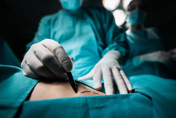 Close up of a plastic surgeon marking the human skin for surgery.