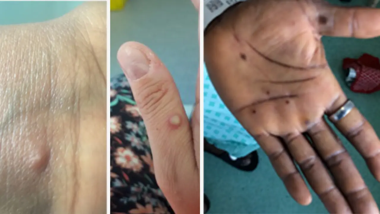 (Imágenes: Red de enfermedades infecciosas de gran consecuencia del NHS de Inglaterra)