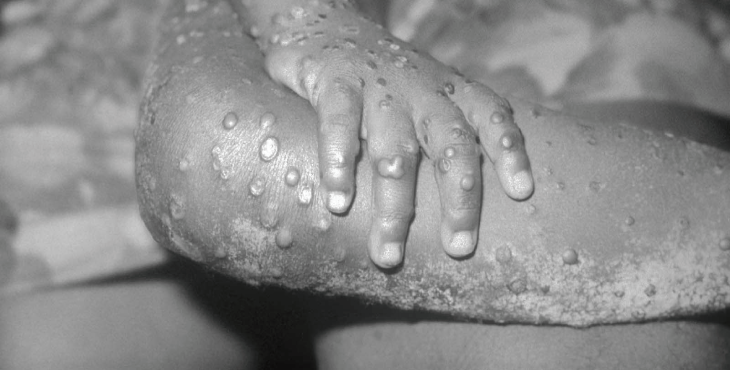 monkepox viruela del mono | Imagen CDC's Public Health Image Library