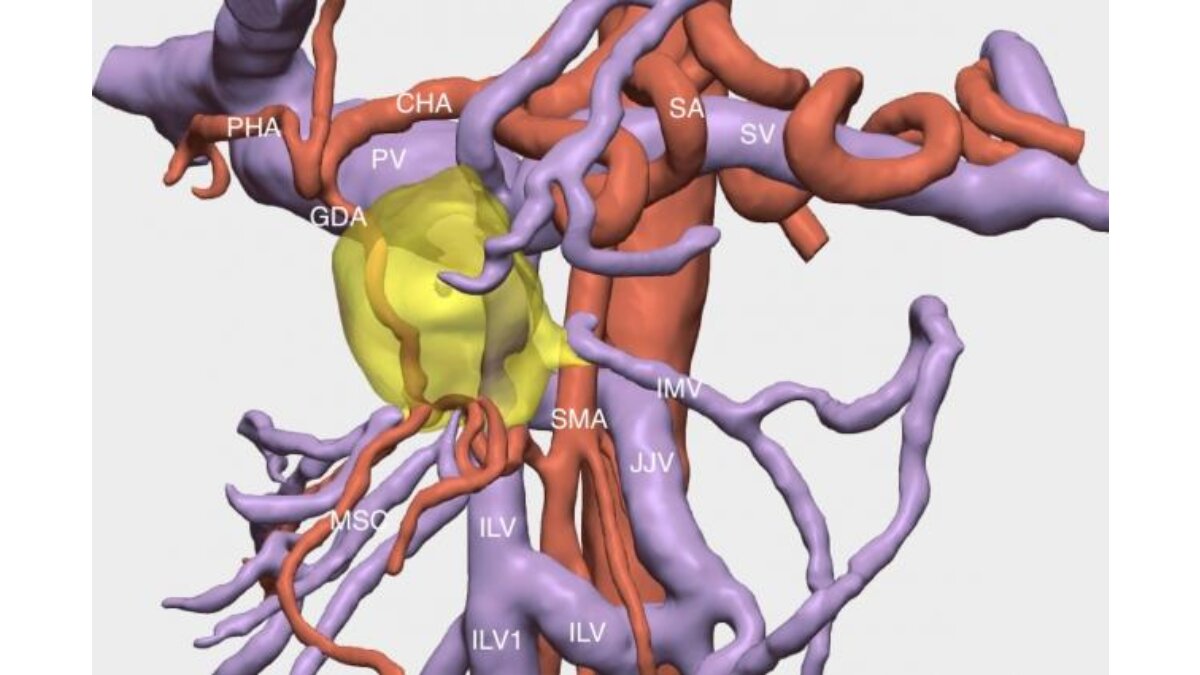 Reconstrucció del tumor en tres dimensions (Autoria imatge, Cella Medical Solutions)