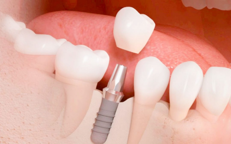 Los implantes dentales: los mejores aliados de tu sonrisa