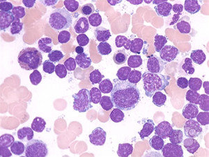 Descubren que células de leucemia se hacen no cancerosas por epigenética