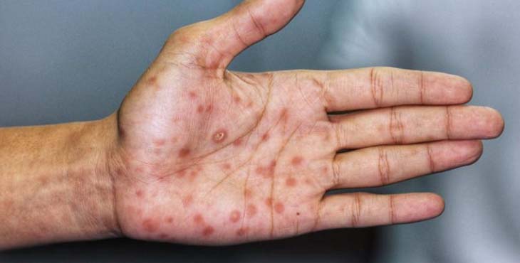 Sanidad confirma 59 casos positivos de viruela no humana