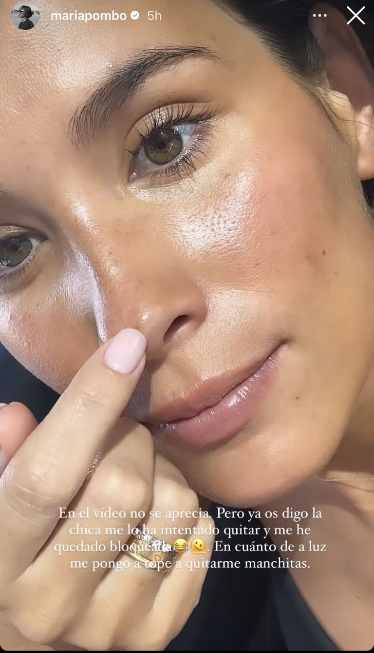 Imagen De La Reacción En La Piel Por La Que María Pombo Ha Tenido Que Ir A Un Especialista 1 Maria Pombo Manchas Piel Embarazo Cosmopolitan 641B646926282